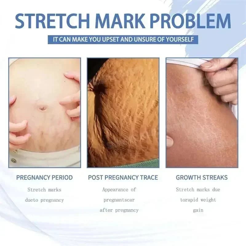Stretch Marks Removal Cream Light Lines Postpartum Obesity Pregnancy Powerful Fast Absorption - thumbnail 9