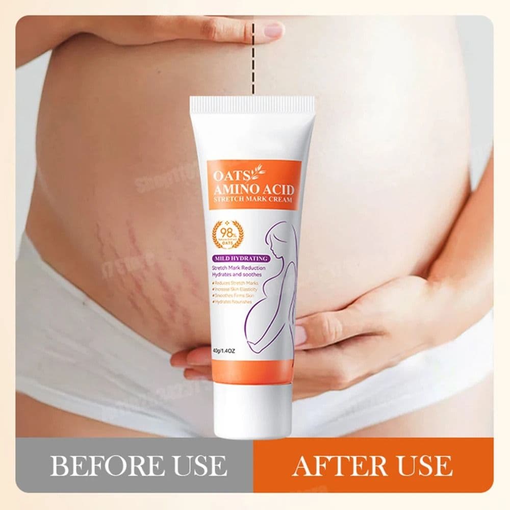 Stretch Marks Removal Cream Light Lines Postpartum Obesity Pregnancy Powerful Fast Absorption - thumbnail 4