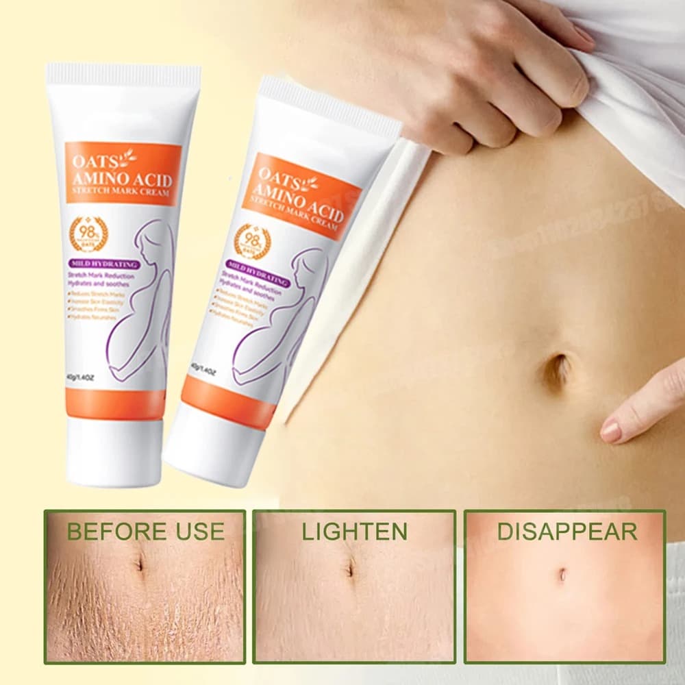 Stretch Marks Removal Cream Light Lines Postpartum Obesity Pregnancy Powerful Fast Absorption - thumbnail 10