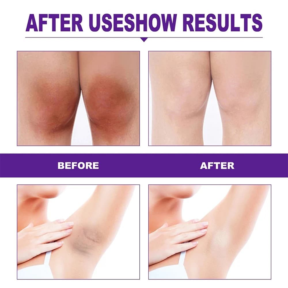Whitening Cream Private Parts Underarm Bleaching Serum Whiten Butt Knee Brighten Inner Thigh Intimate Parts Dark Remove - thumbnail 4